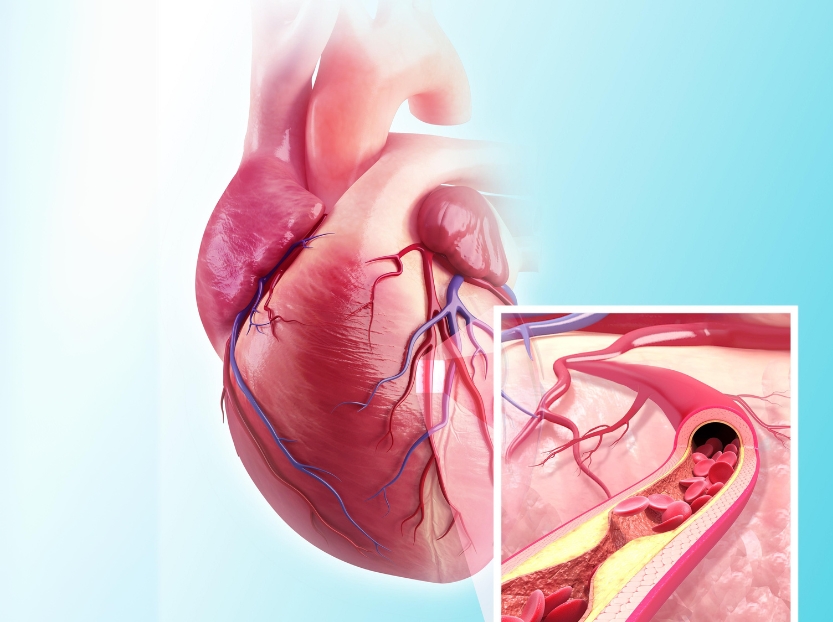 Ensaio clínico: o primeiro bioimplante cardíaco com células-tronco do cordão umbilical revoluciona o tratamento do infarto do miocárdio